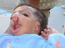 Child with Cleft deformity